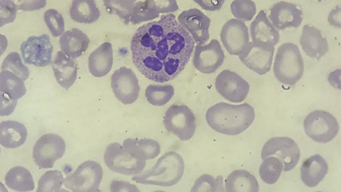 The peripheral smear shows characteristic hypersegmented neutrophil and macro ovalocytes which is found in megaloblastic anemia