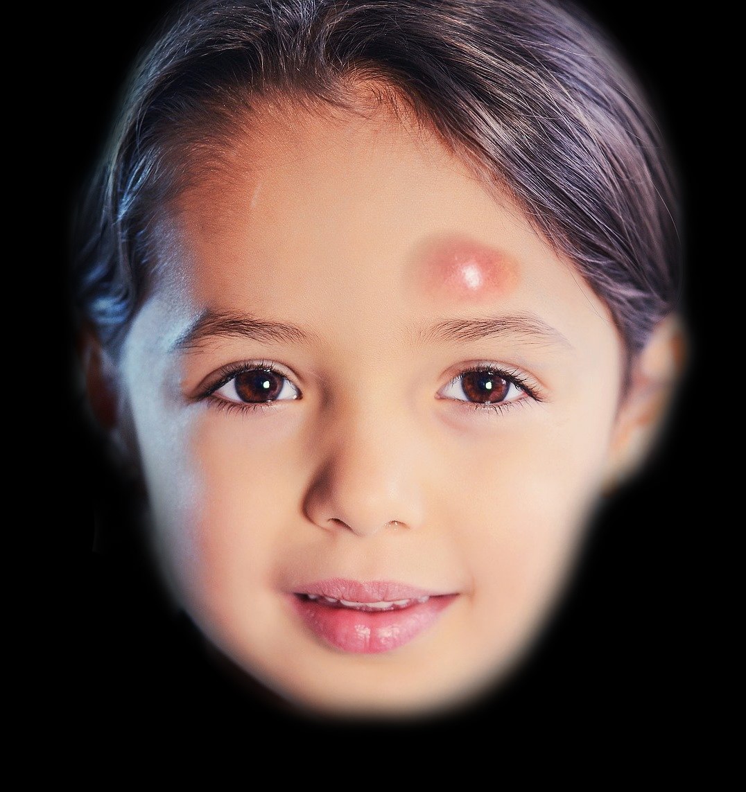 Example of a pott puffy tumor.