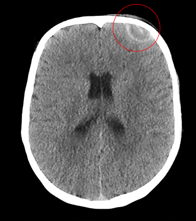 CT head showing pott puffy tumor.
