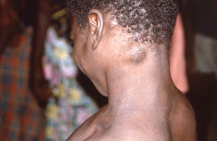 Cervical lymphadenopathy in a child with monkeypox