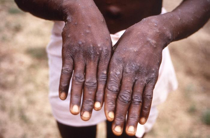 Monkeypox lesions on hands