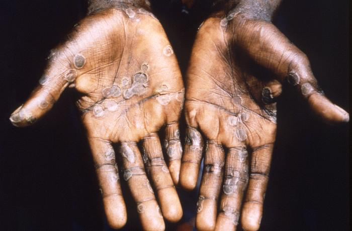 Monkeypox lesions on palms