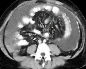 Encapsulating Peritoneal Sclerosis on CT Abdomen/Pelvis.