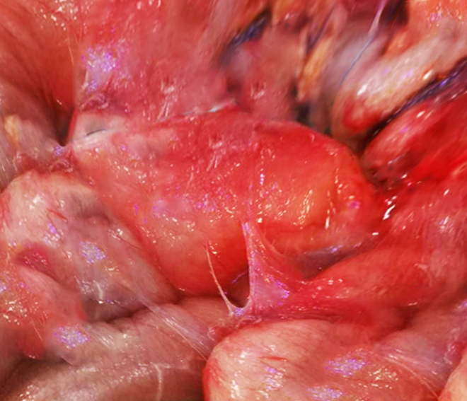 Gross image of Encapsulating Peritoneal Sclerosis