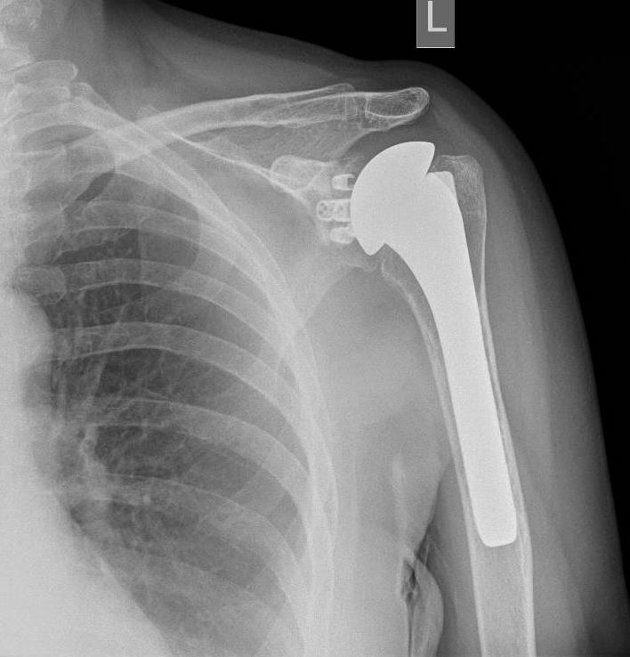 <p>Anatomical Shoulder Arthroplasty. Left shoulder anteroposterior x-ray shows anatomical shoulder arthroplasty.</p>