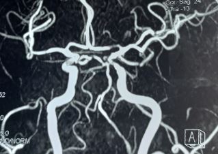 Stenosis of the first segment of the left anterior cerebral artery