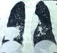CT image of carcinoma lung