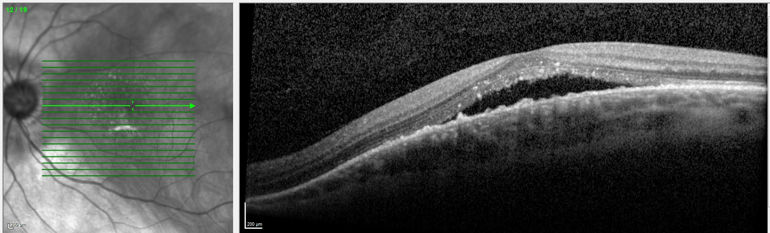 Dome shaped maculopathy with subretinal fluid
More apparent in vertical OCT scan