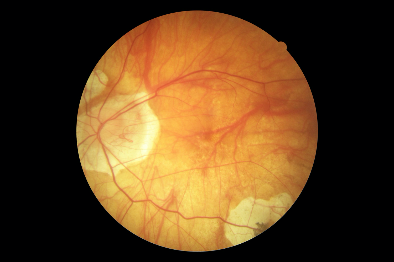 Grade 3 pathological myopia with diffuse chorioretinal atrophy