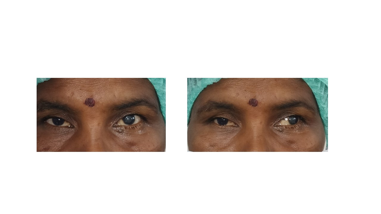 Clinical image of the patient depicting orthotropia for near and exotropia after the fusion is suspended following alternate cover test suggestive of intermittent exotropia