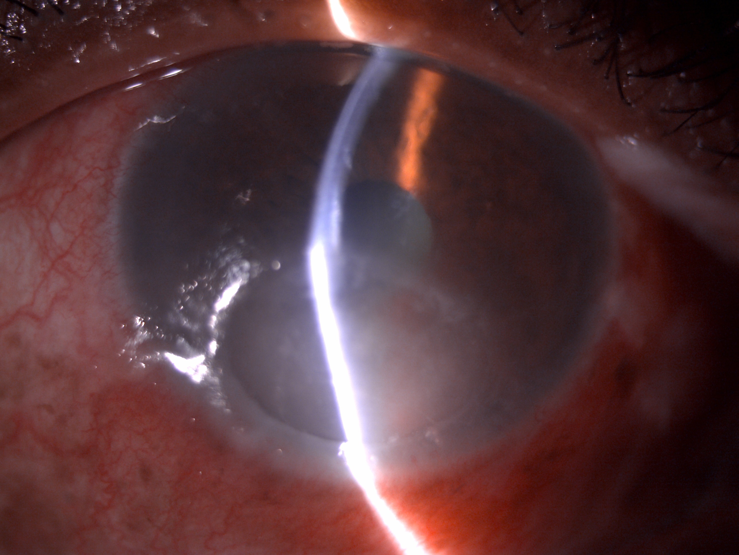 Slit lamp image depicting conjunctival congestion, 5x5 mm epithelial defect, mid stromal infiltrate with corneal thinning pos