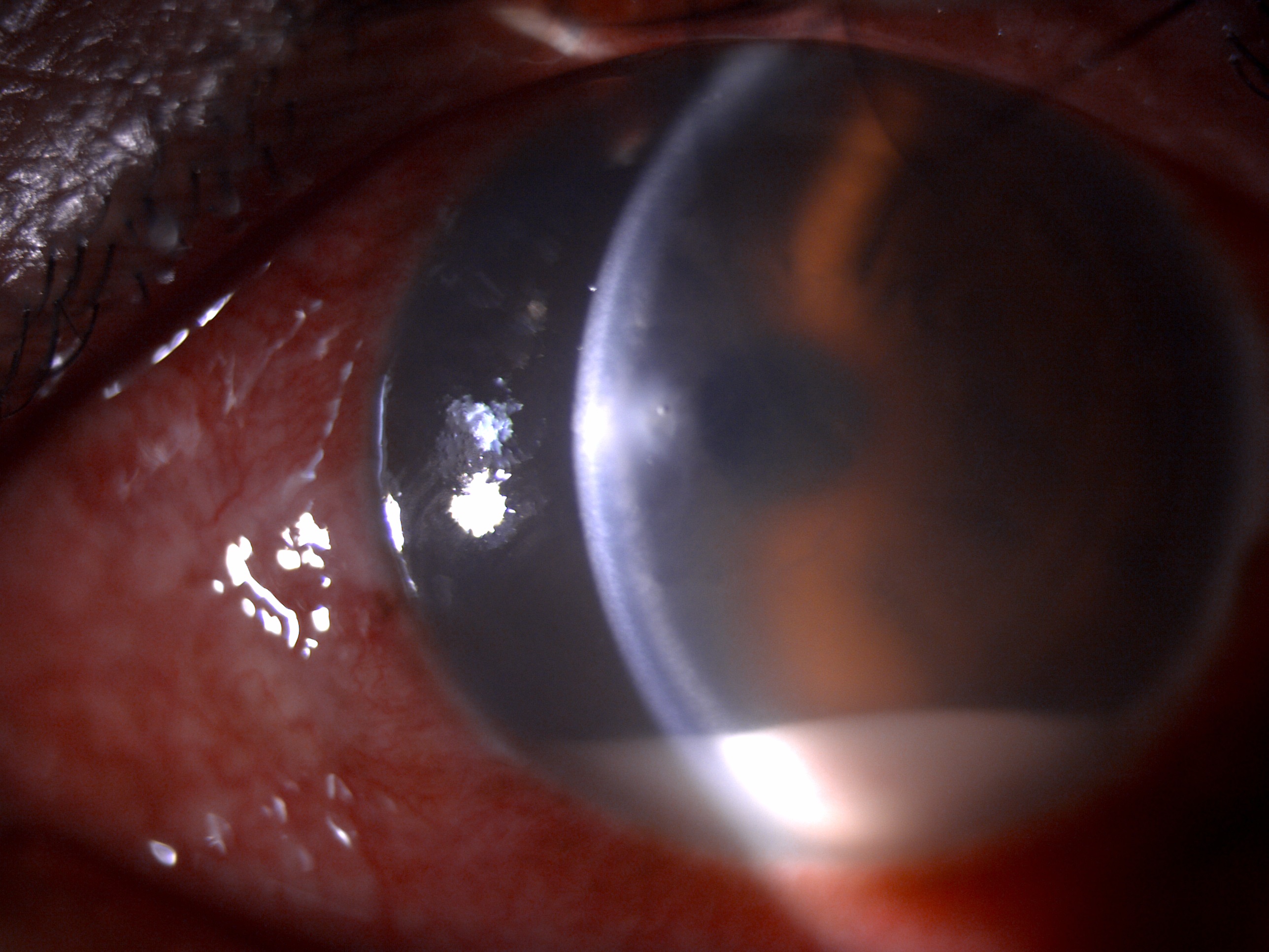 Slit lamp image depicting diffuse conjunctival congestion, 2x2 mm circular anterior stromal corneal infiltrate, stromal edema