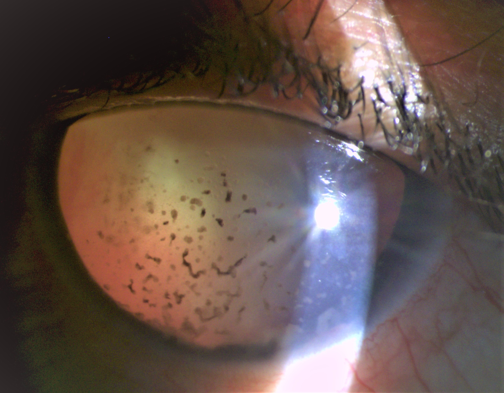 Phaco-anaphylactic glaucoma