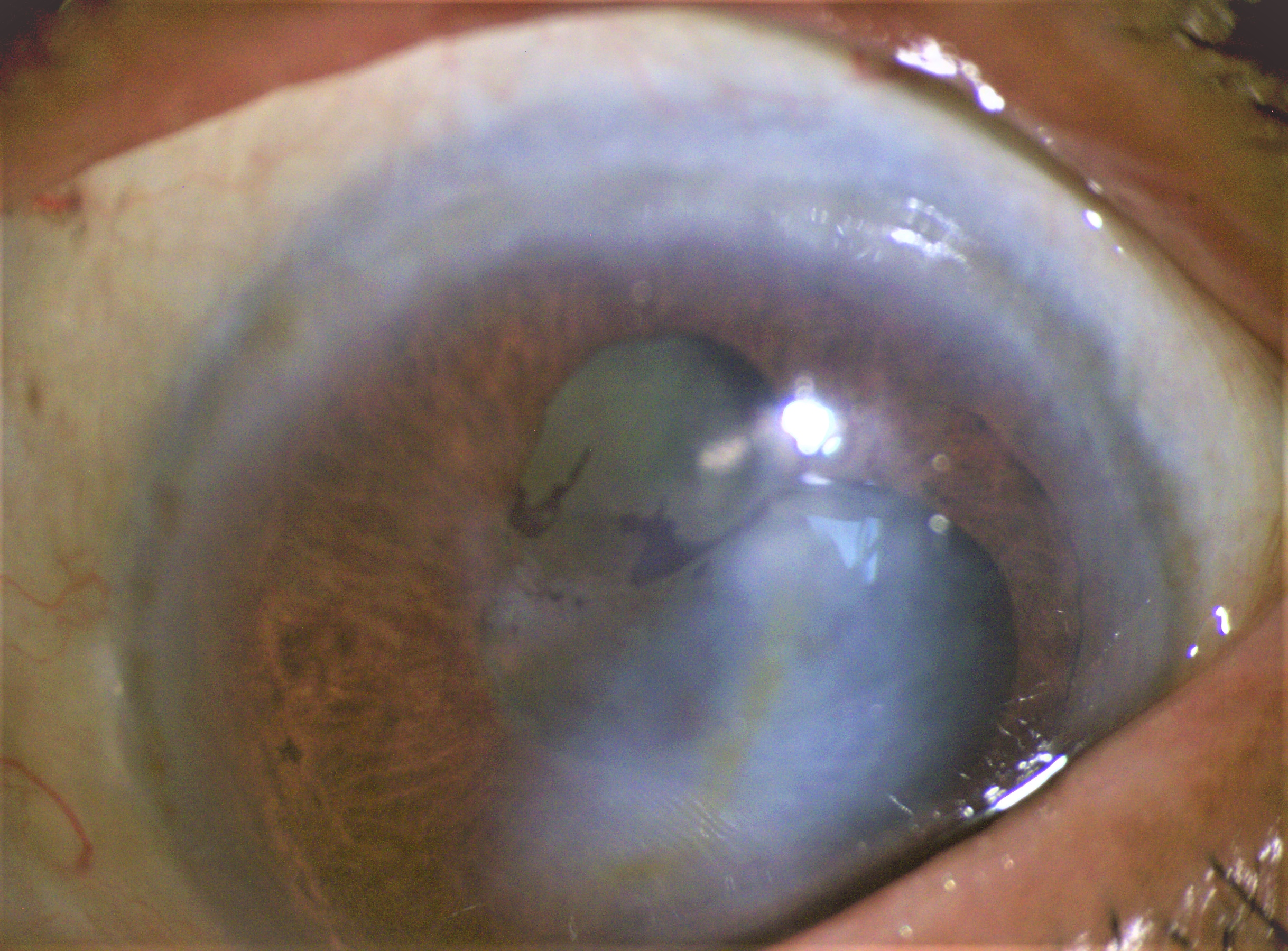 Phacolytic Glaucoma