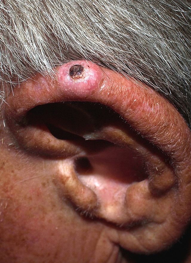 Skin changes typical for chondrodermatitis helicis nodularis over the pinna of the left ear.