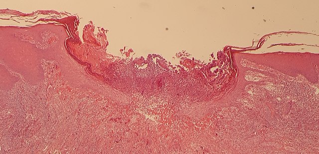 Histopathology of chondrodermatitis nodularis chronica helicis
