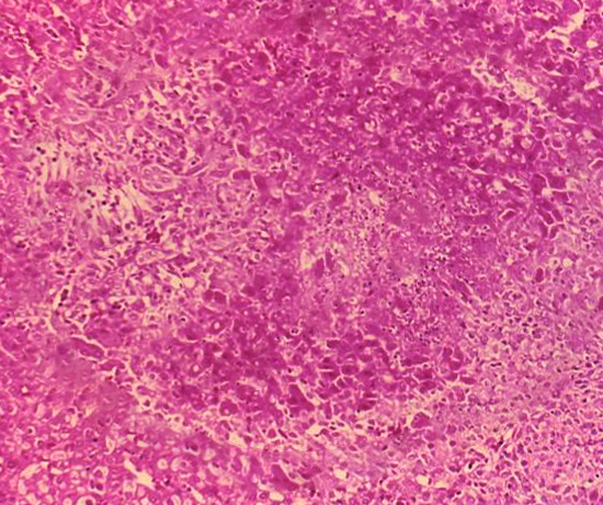 Histology showing caseating granuloma caused by brucellosis infection.