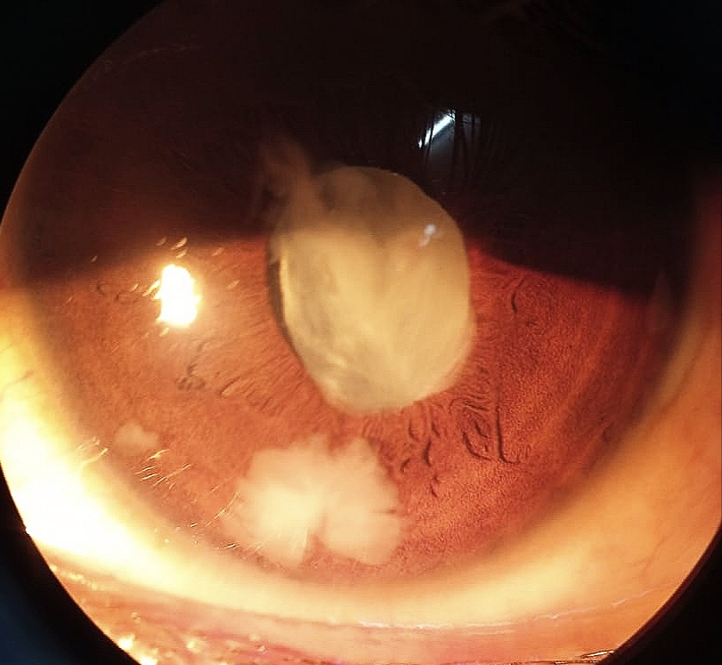Lens particle glaucoma