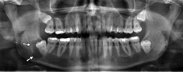 <p>Radiograph, Odontogenic Cyst in the Right Mandible</p>