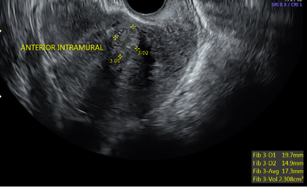 Transvaginal ultrasound sagittal image of a fibroid uterus. Pictured is an anterior intramural fibroid with surround acoustic shadowing.