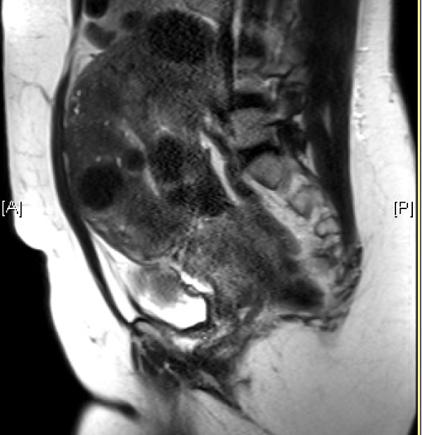T2 sagittal MRI image of enlarged fibroid uterus. Relationship of the fibroids to the hyperechoic endometrium is easily identified. 