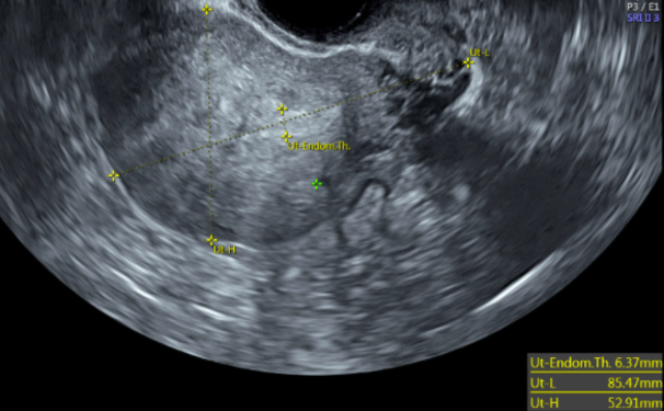 TVUS sagittal view of a uterus with anterior intramural mass with ill-defined borders vs thickened heterogenous myometrium, suspicious for adenomyosis