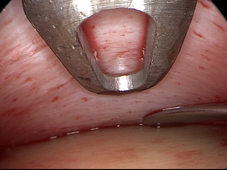 Endoscopic view of elevation of the frontal periosteum off the frontal bone during endoscopic brow lifting.