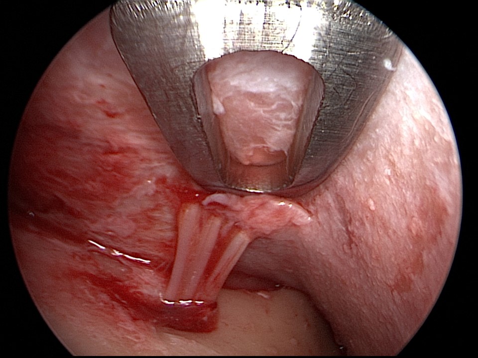 Endoscopic view of the supraorbital nerve as several of its branches emerge from a foramen. The supraorbital nerve typically emerges from the skull via a notch, but a foramen is present in 25-33% of cases.