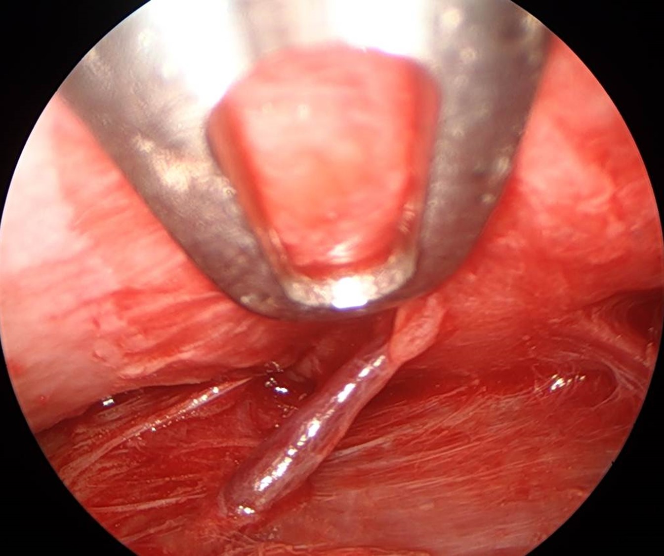 Endoscopic view of the medial zygomaticotemporal, or "sentinel," vein as it traverses the potential space between the temporalis fascia and the temporoparietal fascia, typically within 10 mm of the frontal branch of the facial nerve.