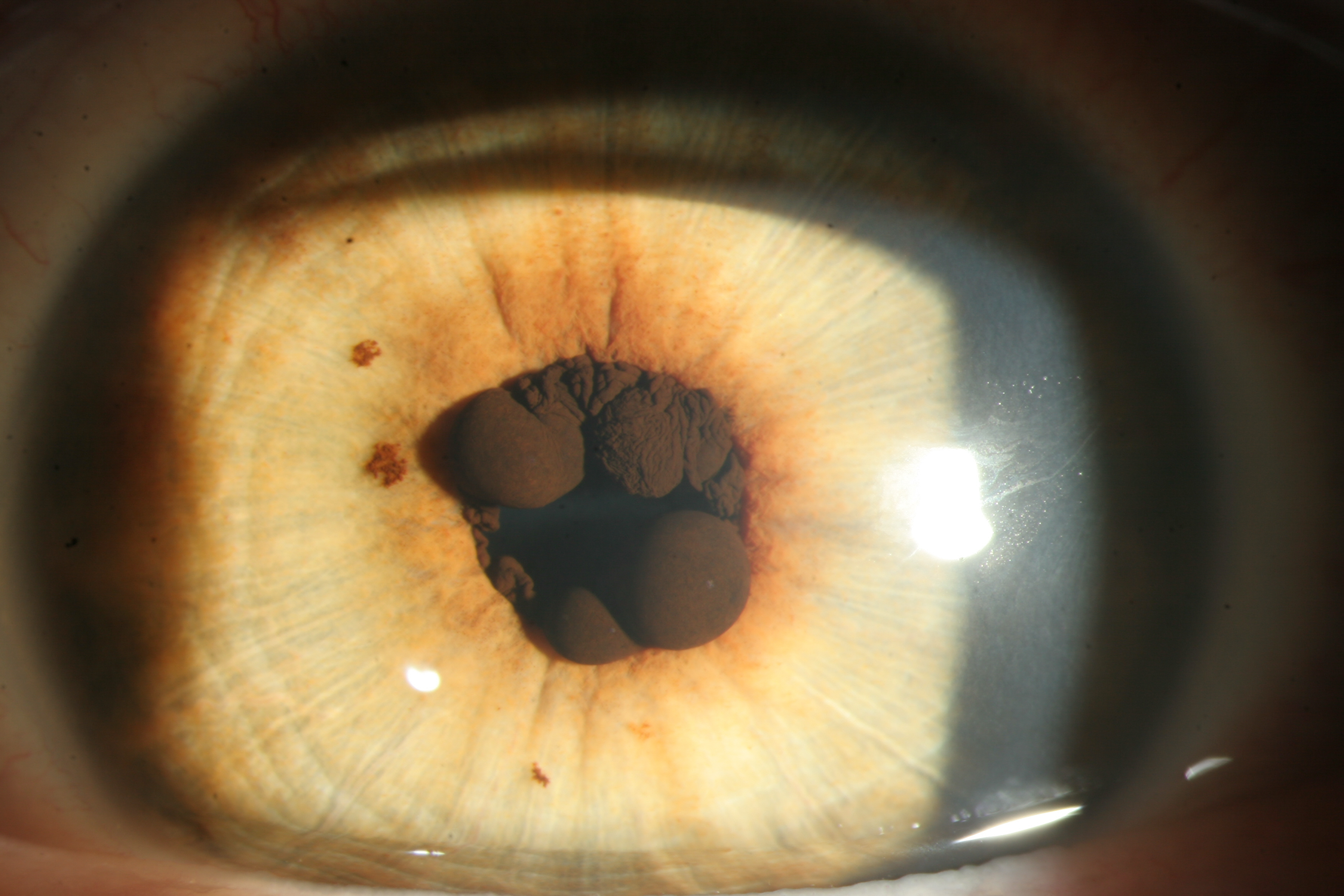 <p>Pigmented Epithelial Cysts on the Iris