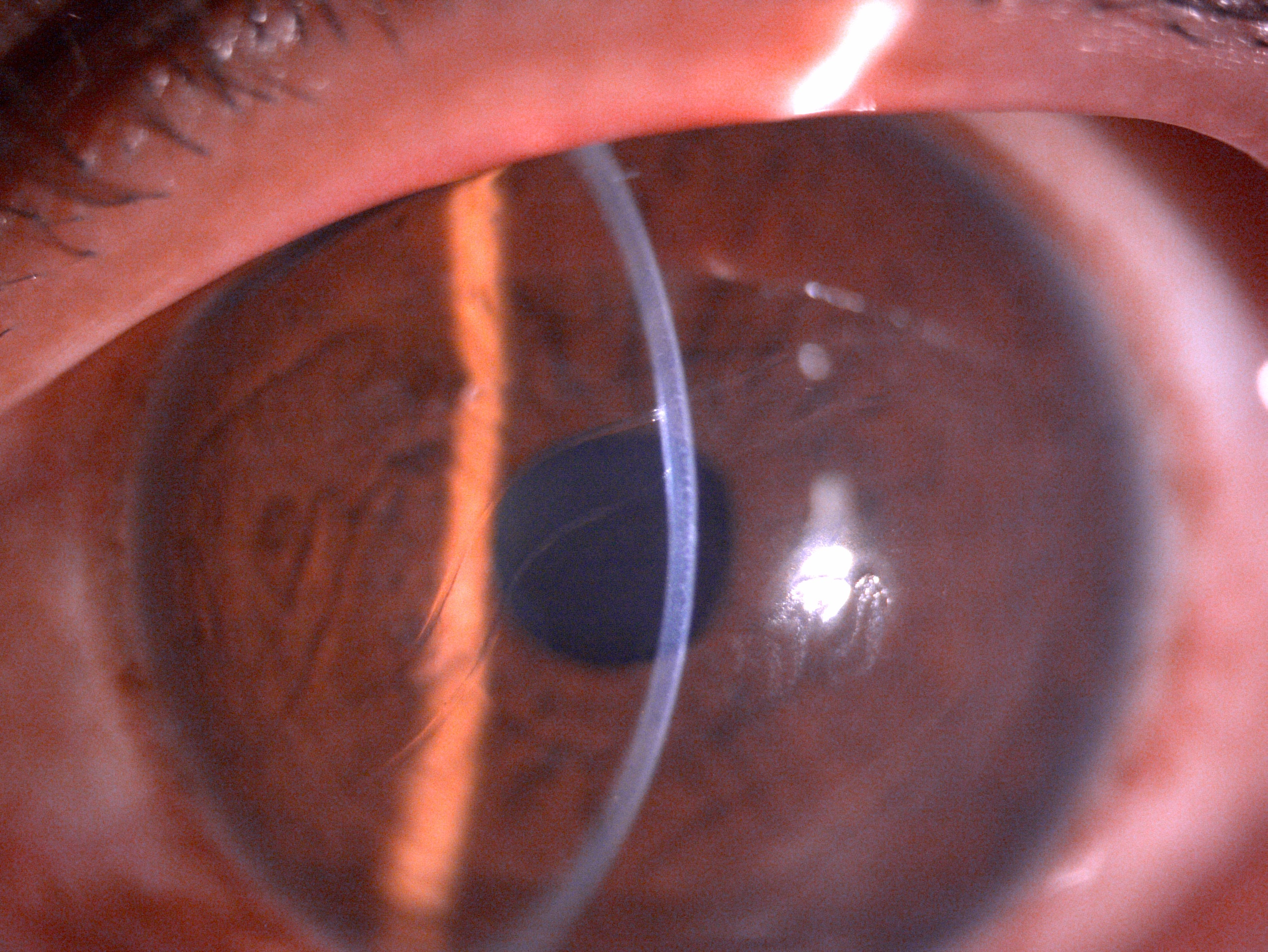 Slit lamp image of the child depicting megalocornea and horizontal oblique breaks in descemet membrane suggestive of Haab's striae secondary to raised intraocular pressure and stretching of the cornea