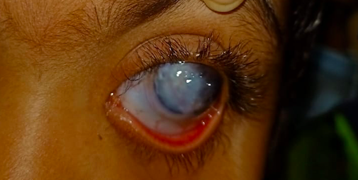 Slit lamp image of the child depicting mild conjunctival congestion, lower tarsal conjunctival hyperaemia, megalocornea, near total corneal opacification with deep stromal vascularization suggestive of long standing chronic primary congenital glaucoma 