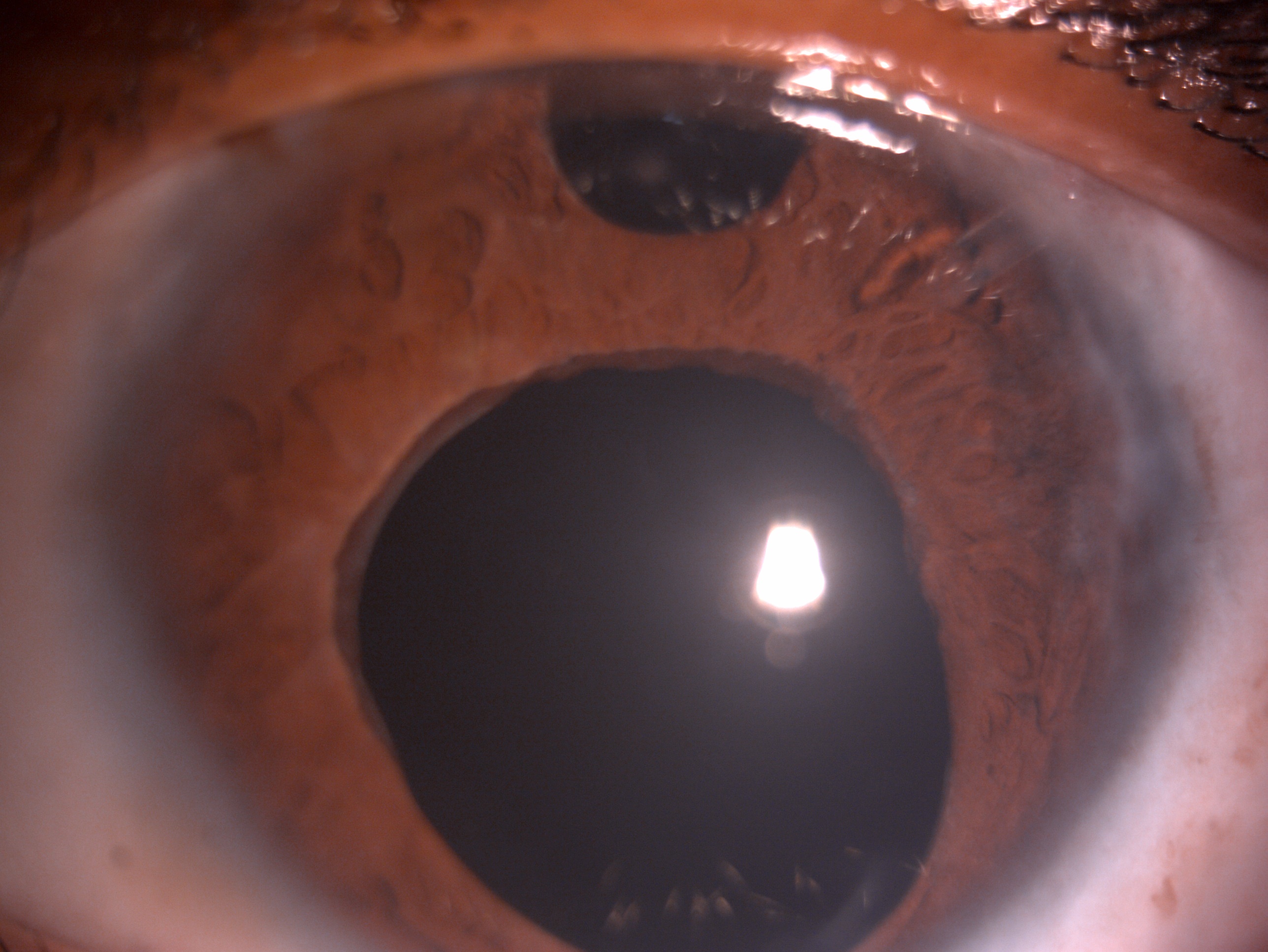Slit lamp image of the child depicting megalocornea, tube shunt in the anterior chamber, surgical peripheral iridectomy, dilated ischemic pupil and aphakia post glaucoma drainage device for recalcitrant primary congenital glaucoma refractory to angle and filtration surgery