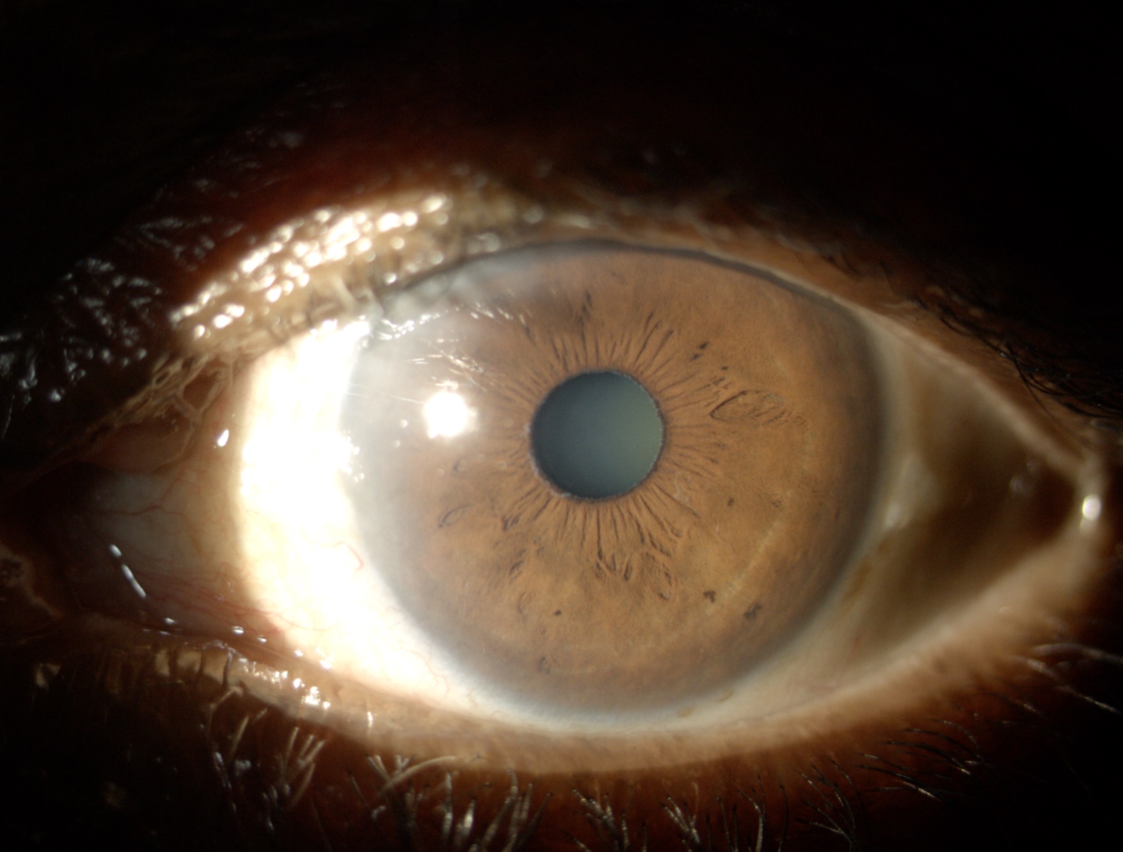 Slit lamp photograph of a left eye demonstrating pseudoexfoliation material on the pupillary margin