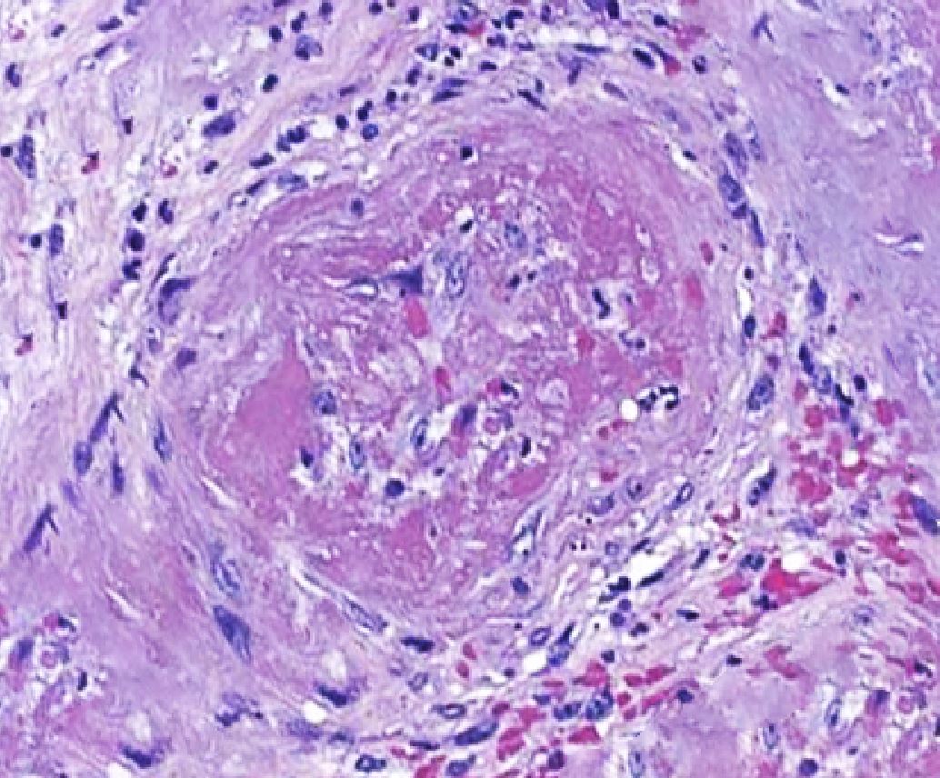 Pathological changes of microscopic polyangiitis showing fibrosis.
