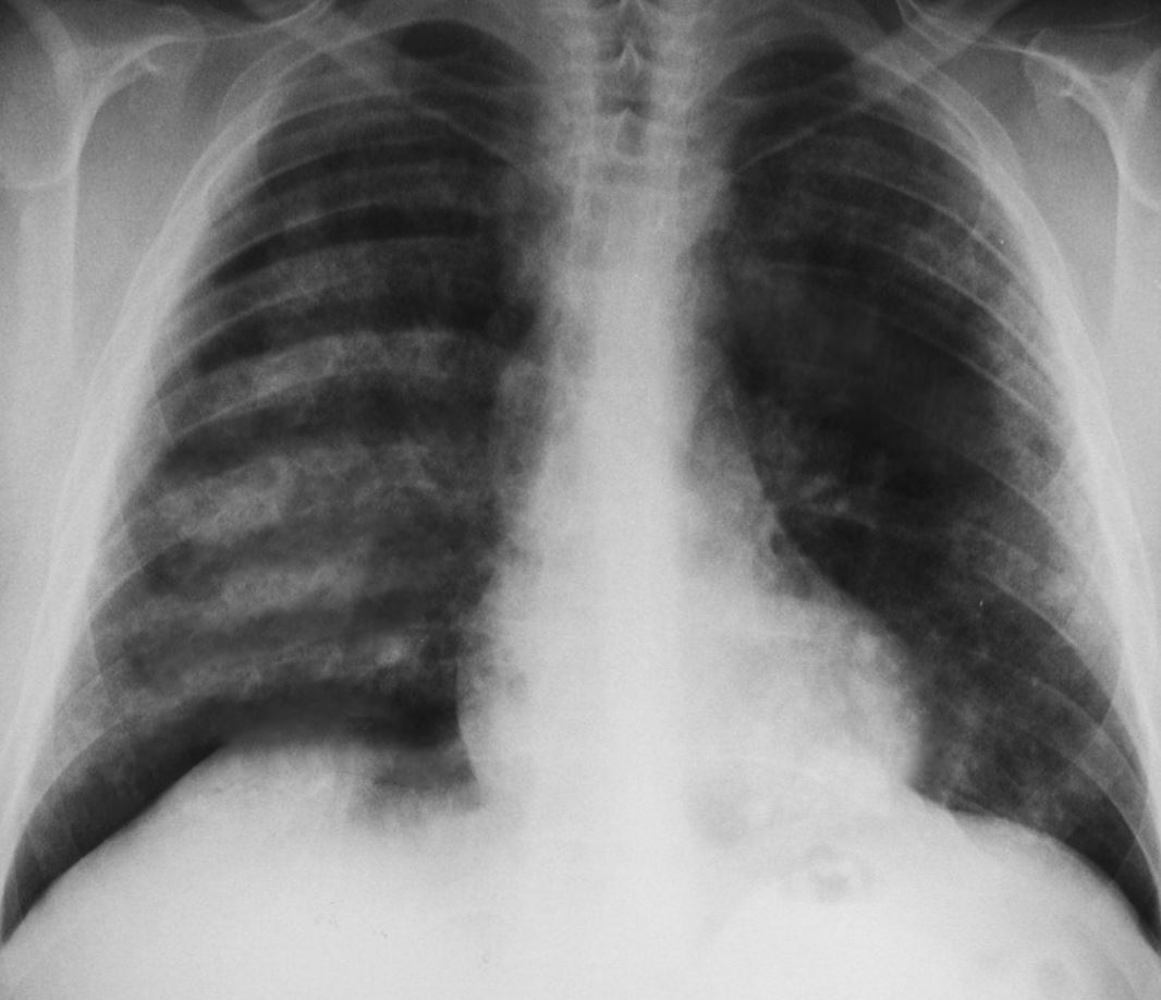 Chest x-ray showing pulmonary hemorrhages seen in Goodpasture syndrome.