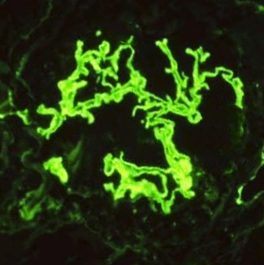 Immunofluorescence staining for IgG showing linear staining of the glomerular basement membrane.