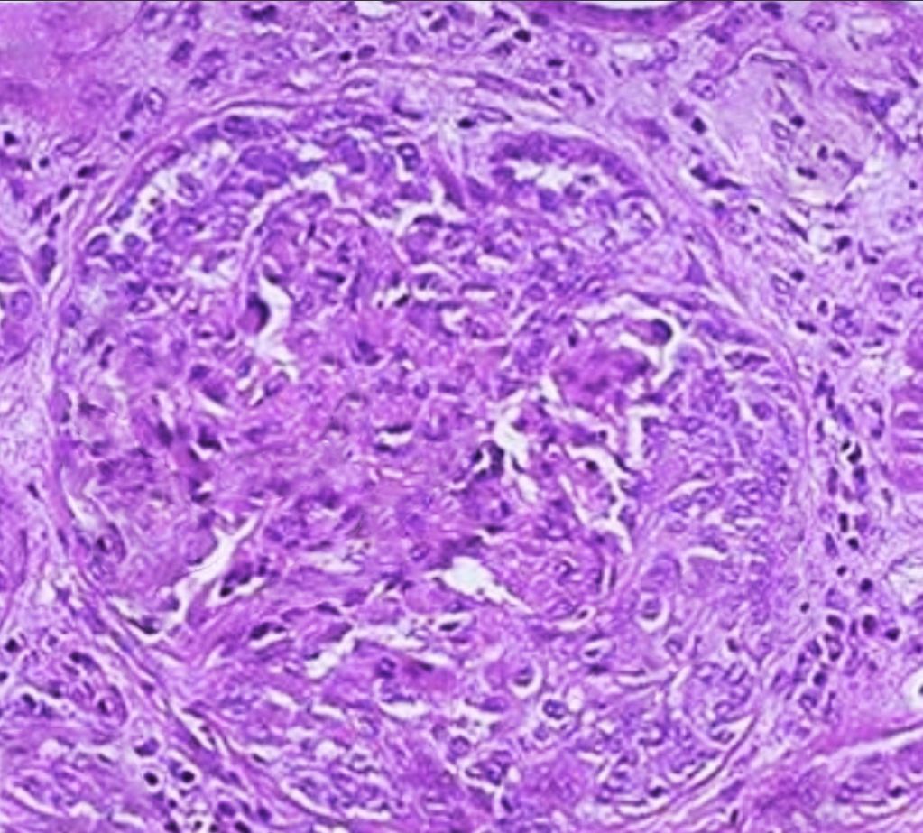 Renal biopsy showing crescentic glomerulonephritis seen in Goodpasture syndrome.