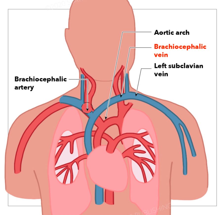 Brachiocephalic artery, vein, subclavian vein, aortic arch.