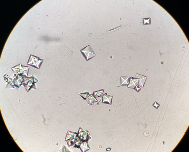 Microscopic view of calcium oxalate crystals in urine.