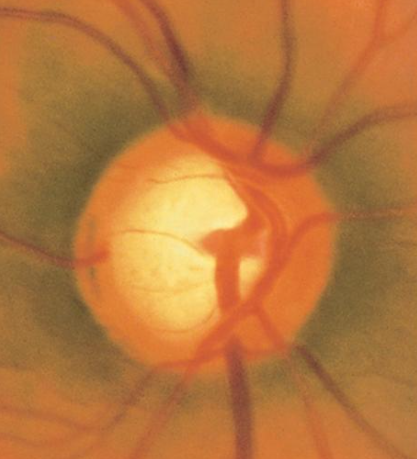 A zoomed-in fundus image showing a cup-to-disk ratio of 0.75 of the optic nerve, indicating a high level of glaucoma suspicion.