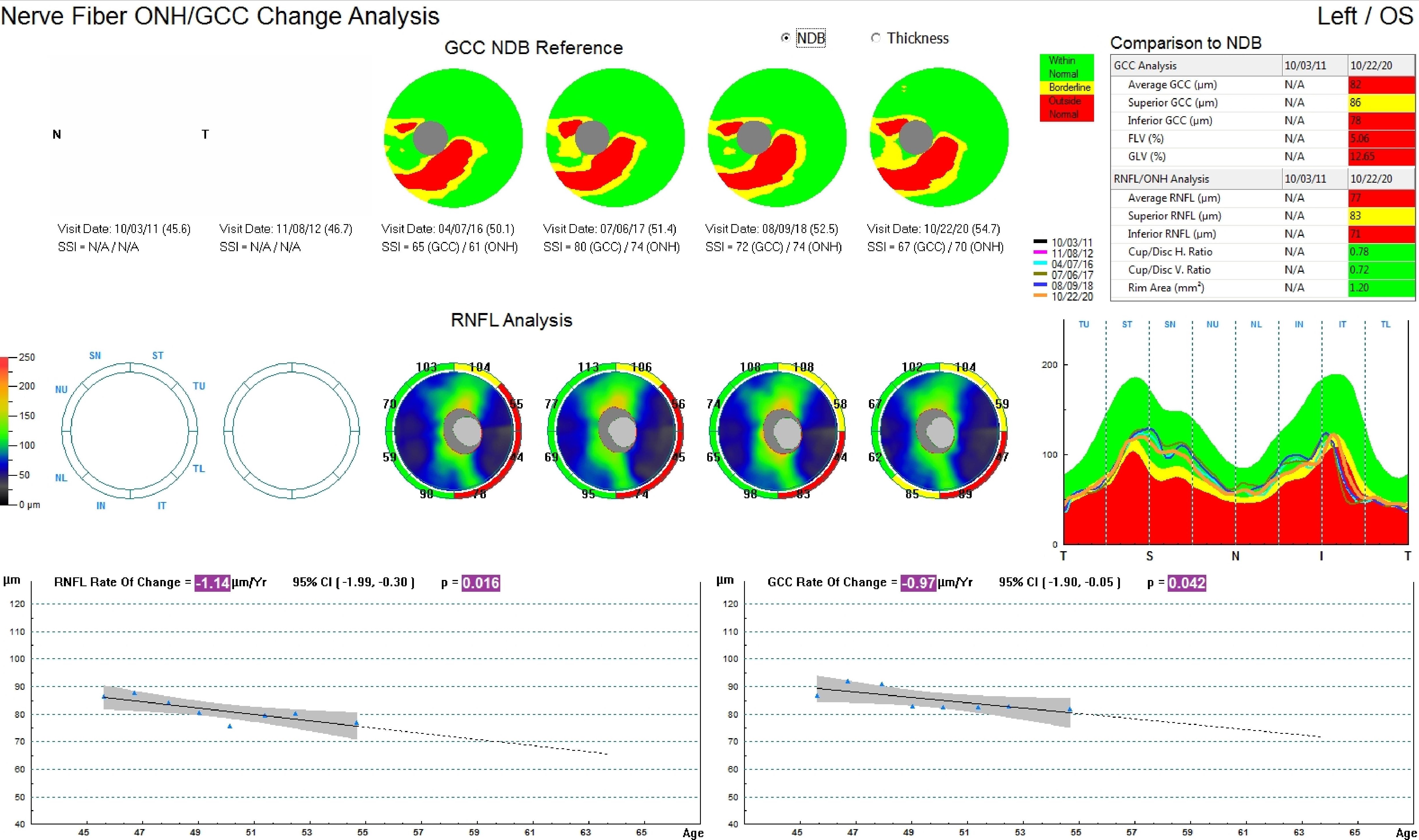 This image represents the change analysis over a nine year period of a male patient diagnosed with glaucomatocyclitic crisis in the left eye. Through this nine-year follow-up period his rate of GCC loss is -0.97microns/year and RNFL is -1.14microns/year . Both GCC and RNFL appear to have significant rates of loss as shown by their P values. 