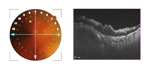 Figure 1: color fundus picture showing hazy vitreous media with multiple sub retinal yellow deposits and corresponding optical coherence tomography scan showing hyper reflective nodules in sub retinal space
