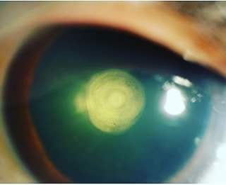 Classical slit lamp image of the patient depicting onion ring shaped discoid plaque like opacity densely adherent to the central posterior capsule suggestive of posterior polar cataract