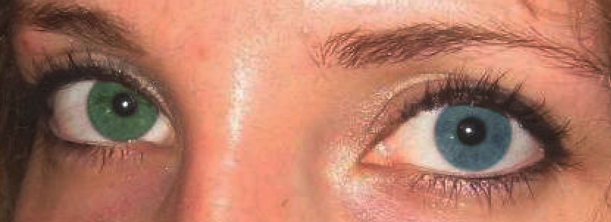 Example of heterochromia.