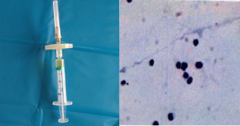 Figure 2: Vitreous specimen collected in syringe and histopathological examination showing uniform population of small lympho