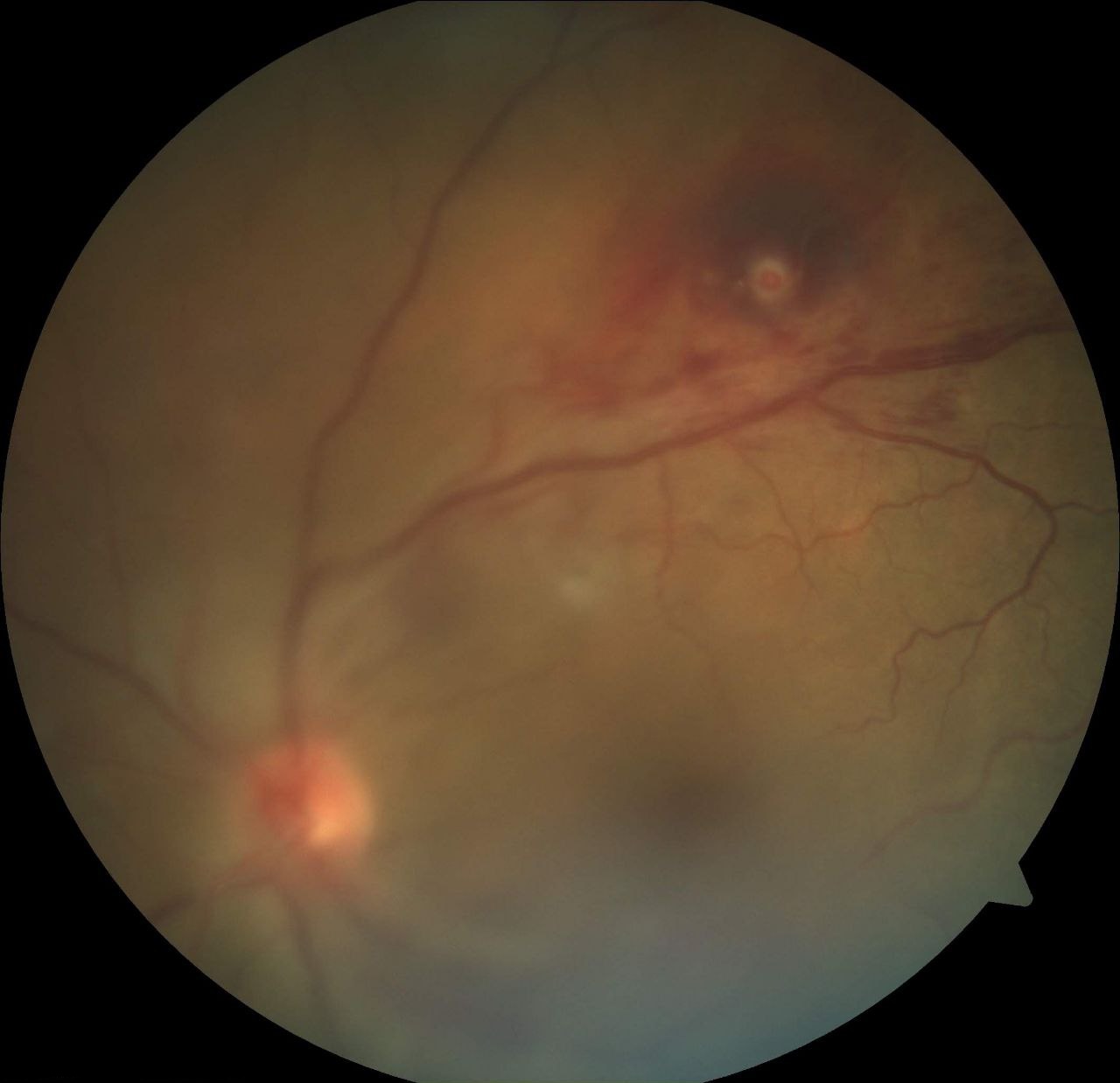 Color fundus image of the left eye shows media haze due to vitreous hemorrhage. Retinal artery macroaneurysm is seen superotemporally.