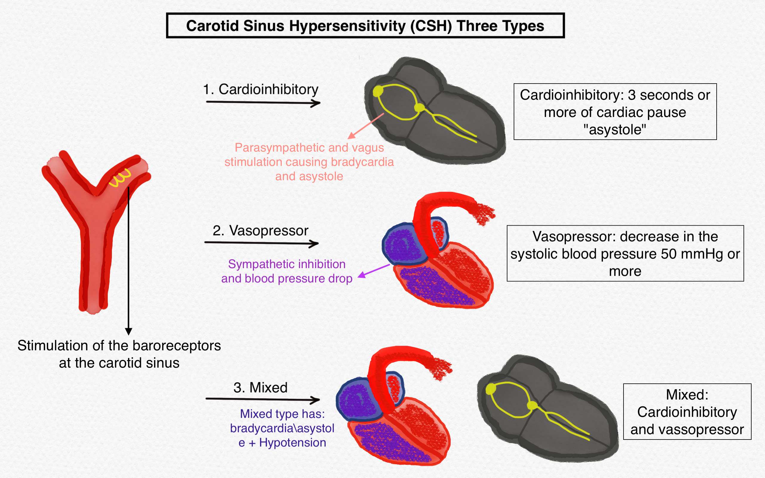 <p>The Three Types of Carotid Sinus Hypersensitivity</p>