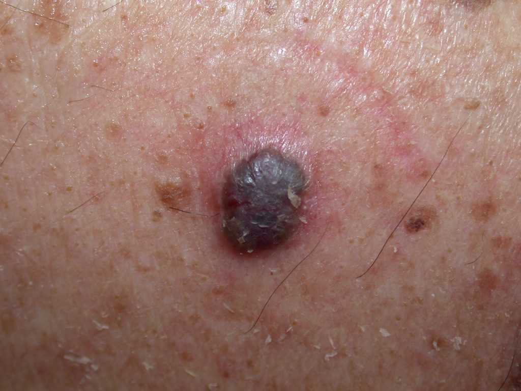Basal Cell Carcinoma, Pigmented
