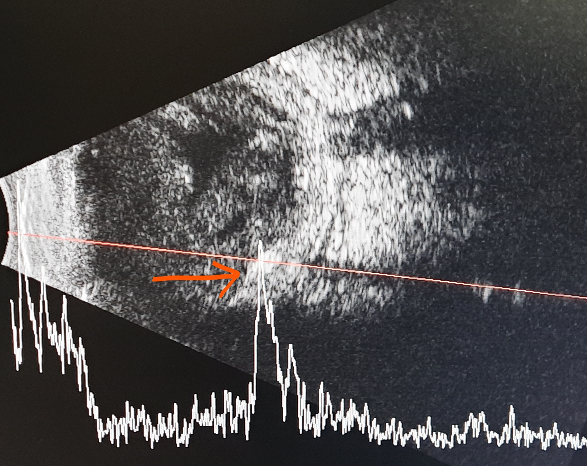 Ultrasound B scan of eye showing a metallic foreign body over the retina (orange arrow). It is hyperechoic, has 100% spike on A scan with a back shadow. 